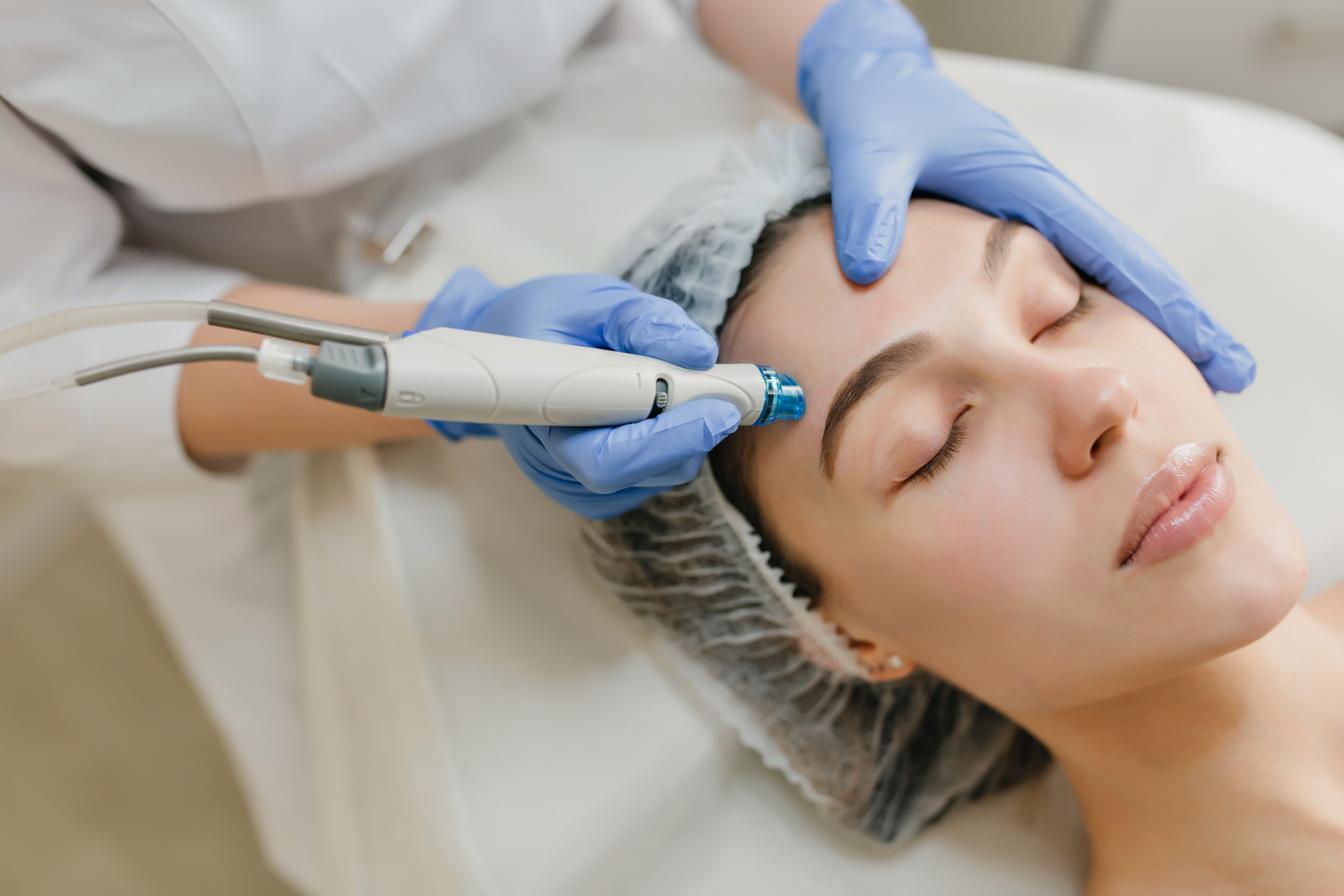 Microneedling treatment